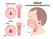 Croup upper airway obstruct virus voice box vocal cord tube swollen noise baby child cold flu sick stuffy runny nose fever common kids lung covid 19 RSV tract high pitched