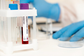 A test tube with a sample of blood infected with monkeypox, close-up.In the blurry background, a medic working in the laboratory.Epidemic of monkeypox in Europe and the USA.