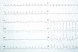 A positive stress induced myocardial ischemia with significant horizontal ST depression changes in the stress ECG ElectroCardioGram test, Patient was exercised according to Bruce protocol