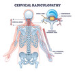Cervical radiulopathy as painful neck nerve irritation outline diagram. Labeled educational medical compression problem description with skeletal and pinched spinal nerve anatomy vector illustration.