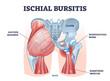 Ischial bursitis or ischiogluteal weaver's bottom condition outline diagram. Labeled educational scheme with muscle inflammation and liquid filled bursa vector illustration. Human body back anatomy.