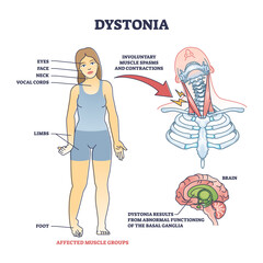 Sticker - Dystonia disorder as abnormal muscle spasms and contractions outline diagram. Labeled educational scheme with affected body areas and symptoms vector illustration. Result of basal ganglia dysfunction.