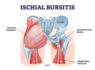 Poster - Ischial bursitis or ischiogluteal weaver's bottom condition outline diagram. Labeled educational scheme with muscle inflammation and liquid filled bursa vector illustration. Human body back anatomy.