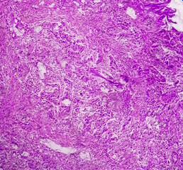 Canvas Print - Bladder Cancer: High grade transitional cell carcinoma (TCC), Urothelial carcinoma