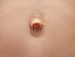Small umbilical hernia, belly button of a 9 year old boy