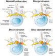 Normal lumbar disc. Disc protrusion. Disc extrusion. Disc sequestion. Labeled illustration