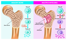Medical Illustration Shows The Difference Between Healthy Bone And One That Is Eroded By Multiple Myeloma, Which Is Caused By Damaged DNA.