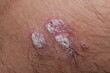 problem skin psoriasis on the body. Psoriasis is an autoimmune disease that affects the skin causing red, scaly skin inflammation.