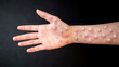MONKEYPOX. The arm is blistered from monkeypox. Virus, epidemic, disease. Black background.