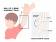 Child elbow dislocated injury that cause ulna bone fracture nursemaid painful head of radius subluxation young slight bend