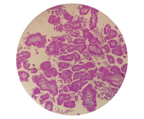 Wall Mural - Histology of metastatic papillary adenocarcinoma.