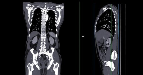 Wall Mural - CT SCAN of Chest and Abdomen with injection contrast media for diagnonsis chest and abdomen disease.