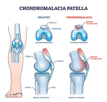 Chondromalacia Patella Knee Breakdown Compared With Healthy Outline Diagram. Labeled Educational Kneecap Tissue Damage With Cartilage Problem And Anatomical Leg Joint Structure Vector Illustration.