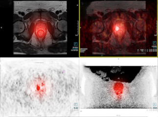 Wall Mural - PET/MRI prostate gland  .