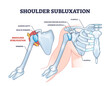 Shoulder subluxation as partial dislocated arm joint problem outline diagram. Labeled educational medical scheme with body skeletal anatomy and dislocated bones vector illustration. Upper body trauma.