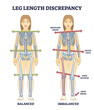 Leg length discrepancy condition with imbalanced skeleton outline diagram. Labeled educational scheme with bones asymmetry and comparison with balanced body vector illustration. Posture symptoms.