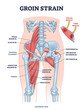 © VectorMine - Groin strain trauma and pulled or torn muscle injury anatomy outline diagram. Labeled educational medical sport problem explanation with body hips and leg overstretching condition vector illustration.