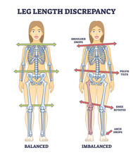 Leg Length Discrepancy Condition With Imbalanced Skeleton Outline Diagram. Labeled Educational Scheme With Bones Asymmetry And Comparison With Balanced Body Vector Illustration. Posture Symptoms.
