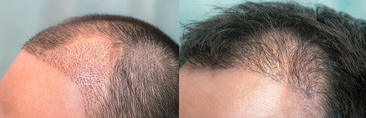 Close up top view of a man's head with hair transplant surgery with a receding hair line. -  1-5 months after Bald head of hair loss treatment.