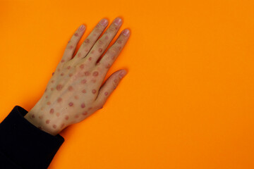 Hand with infected skin on orange background