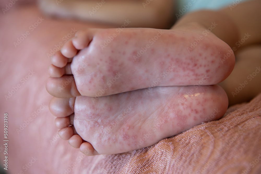 strong-rash-on-child-s-feet-stock-photo-adobe-stock