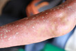 © Trsakaoe - Skin disorder, pepper appearance from scleroderma, autoimmune disease male hand Skin disorder pepper appearance from vitiligo,scleroderma raynaud, medical concept autoimmune disease. Skin disorder,