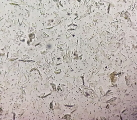 Poster - Microscopic urine examination showing Hyaline cast with plenty pus cell and plenty RBC