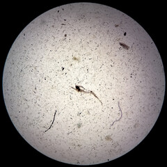 Poster - Microscopic urine examination showing Hyaline cast with plenty pus cell and plenty RBC