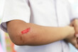 © Apiwat - red bleeding wound on kid arm from hard playing in activity. selective focus.