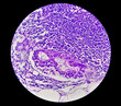 Stomach cancer: Adenocarcinoma of stomach, antrum cancer. High grade acute Inflammation near the tumor nests. Microscopic view.