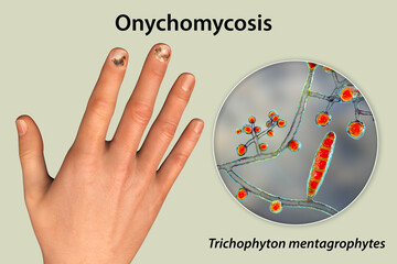 Wall Mural - Human hand with onychomycosis