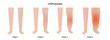 Stages of lymphedema
