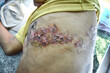© ZAY WIN HTAI - Herpes simplex infection at chest and abdomen.