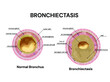 Bronchiectasis. lung disease. Normal bronchus and bronchiectasis.Vector medical illustration.