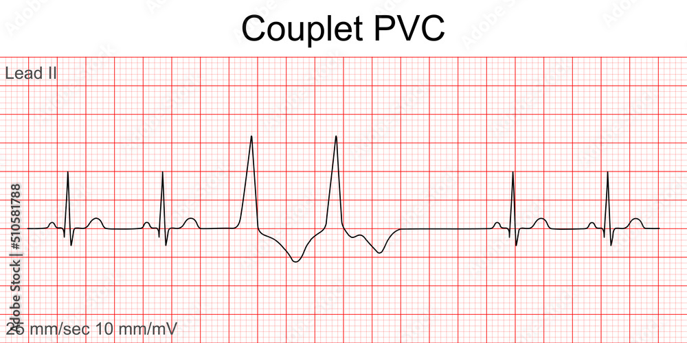 Image vectorielle Stock Electrocardiogram show Couplet Premature ...