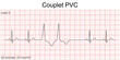 Electrocardiogram show Couplet Premature Ventricular Contraction (PVC) pattern ,Heart beat ,ECG ,EKG interpretation ,Vital sign ,Life line ,Medical healthcare symbol.
