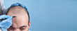 Patient suffering from hair loss in consultation with a doctor. Space for your text