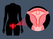 Uterus Polyps Disease