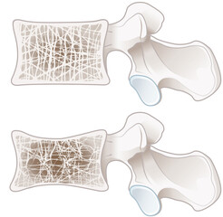 Wall Mural - Osteoporosis, normal vertebra and osteoporotic vertebra. Labeled illustration