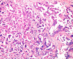 Poster - Ovarian mucinous cystadenocarcinoma