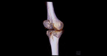 Poster - ct scan of knee joint 3d rendering image turn around on the screen for diagnosis fracture tibia ,fib