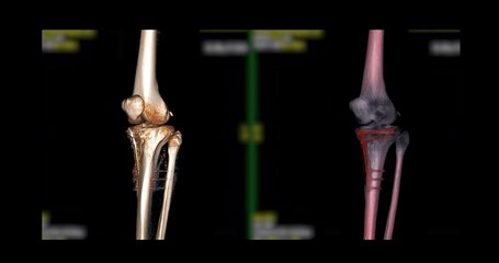 Poster - ct scan of knee joint with fixation metal on the bone 3d rendering image turn around on the screen f