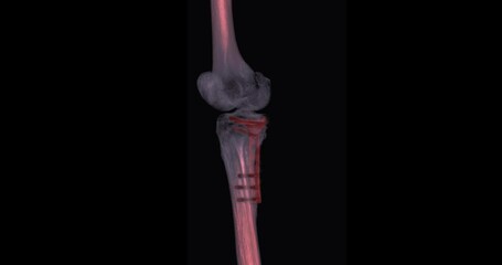 Poster - ct scan of knee joint with fixation metal on the bone 3d rendering image turn around on the screen f