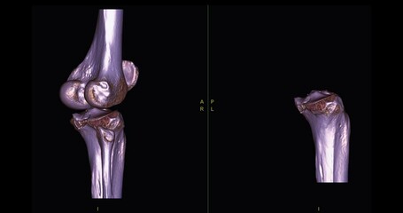 Poster - ct scan of knee joint 3d rendering image turn around on the screen for diagnosis fracture tibia ,fib
