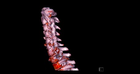 Poster - CT SCAN of Cervical Spine ( C-spine ) patient trauma case 3D rendering image . Medical technology concept.