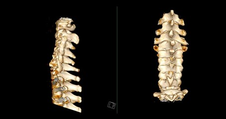 Poster - CT SCAN of Cervical Spine ( C-spine ) patient trauma case 3D rendering image . Medical technology concept.