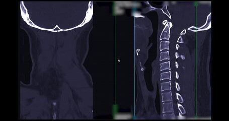 Poster - CT SCAN of Cervical Spine ( C-spine ) patient trauma case case   . Medical technology concept.