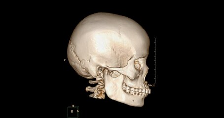Poster - CT Scan of facial bone 3D rendering showng human skull 
 turnaround on the screen .