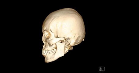 Poster - CT Scan of facial bone 3D rendering showng human skull 
 turnaround on the screen .