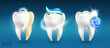 © VectorGirl - Set of dental white teeth, 3d models dental examination teeth, whitening and repair. Realistic vector illustration isolated on blue background